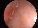 Vaginal Bleeding Caused By Polyp of the Endometrium • Video • MEDtube.net