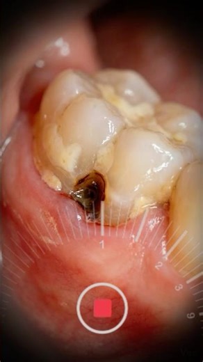 Class V Caries Near Gum Line | 3D Dental Animation