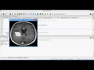 Efficient nnU Net for Brain Tumor Segmentation