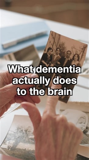 Understanding How Dementia Affects the Brain