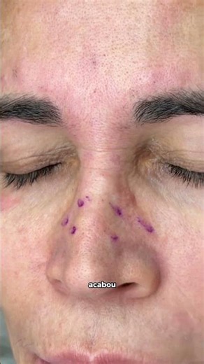 Botulinum toxin in the nasalis muscle