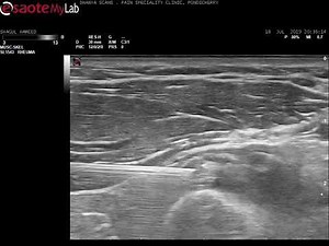 Posterior Interosseous Nerve Hydrodissection