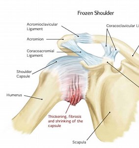 Frozen Shoulder Injection | Ultrasound-Guided Injections