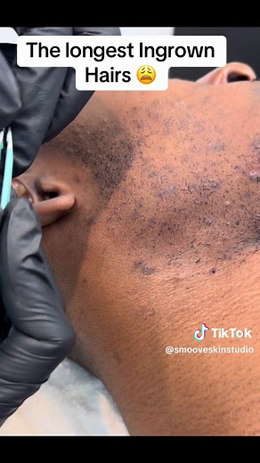 The longest ingrown hair 😲. I had to het them out for my client #ingrownhair #extractions #ingrownhairs #fyp #estheticianlife #esthetician