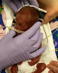 11K views · 476 reactions | This is baby Benson born at 22 weeks and 5 days  Video Credit: Benson Artman - 22 Week Preemie | Right To Life UK | Facebook