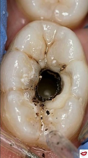 Cavity Drilling & Filling Close-Up – Deep Tooth Decay Removed Instantly