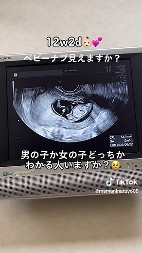 妊娠12週のエコーで性別がわかる？12w2d👶🏻💕