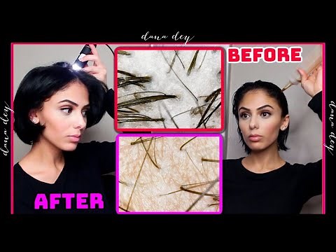 Exfoliating My Scalp Under A Microscope - Scalp Detox Treatment Before & After (INSANE)