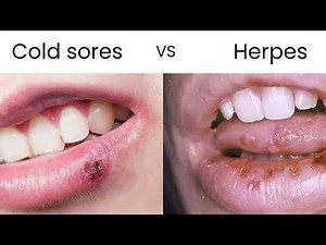 Cold Sores vs. Herpes: What’s the Difference? (HSV-1 & HSV-2 Explained!)