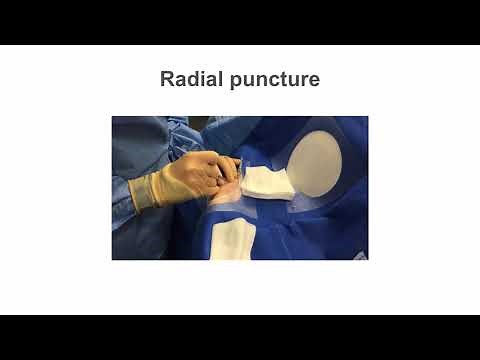 Radial Artery Access: Benefits and Techniques