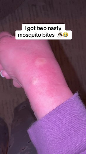 Spring is here…and so are the bugs 😭 #savedbybugbitething #itsathing #bugbitethingbeforeandafter