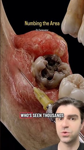 The BEST Way To Fix This Wisdomtooth
