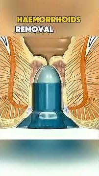 Haemorrhoids removal surgery Ever wondered how haemorrhoids are #Hemorrhoids #Surgery
