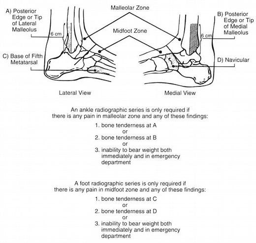 Ottawa Foot, Ankle and Knee rules - Mnemonic