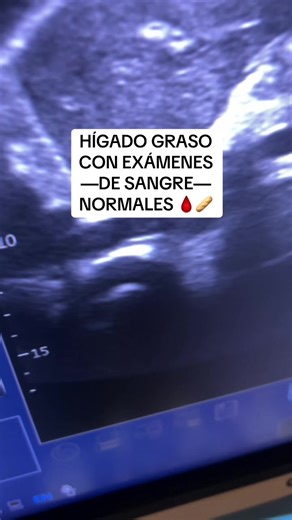 Hígado Graso con Exámenes Normales