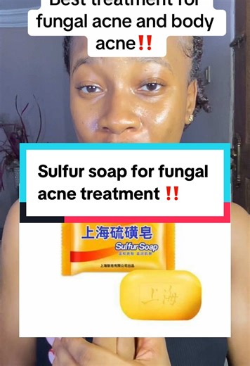 Sulfur Soap for Fungal Acne Treatment: Order Now
