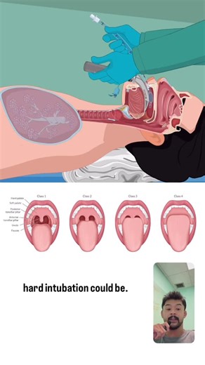 Carl Dela Cruz on Instagram: "This is how we quickly check how hard an intubation might be.🫁🔦 The Mallampati exam compares the tongue to the airway space to help predict how much room we’ll have during laryngoscopy. PUSH mnemonic: • Class I: Pillars, Uvula, Soft palate, Hard palate • Class II: Uvula, Soft palate, Hard palate • Class III: Soft palate, Hard palate • Class IV: Hard palate only Higher classes mean less visibility and a potentially more challenging airway. It’s a quick snapshot we 