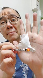 Hand surgery recovery progress update for A1 pulley release due to flexor tendon inflamed swollen causing stuck finger . . . #surgery #doctor #medical #triggerfinger #recovery | So Solomon