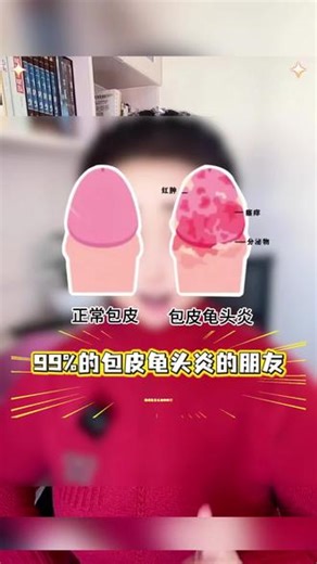 龟头上长红点，该怎么办？这个视频来帮你解答#包皮炎 #包皮裂口 #男性必看 #好物分享 #男性健康