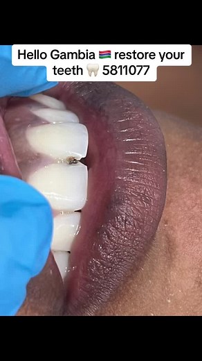 Restore Your Teeth with Fatima Dental in Sukuta