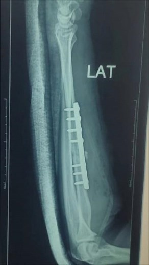 What’s the X-ray Story of a Radius Fracture Fixation? #arm #forearms #muscle #bone #healing #ortho