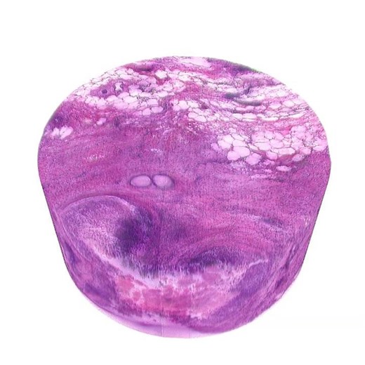 3D Histopathology of Human Breast Cancer; showing invasive carcinoma with fibrotic focus features.