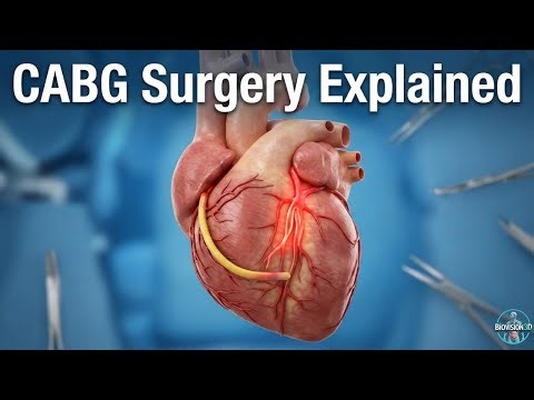 Coronary Artery Bypass Graft (CABG) Surgery Explained | 3D Medical Animation