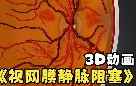 【中英双字】【视网膜静脉阻塞：3D动画】CRVO（central retinal vein occlusion）