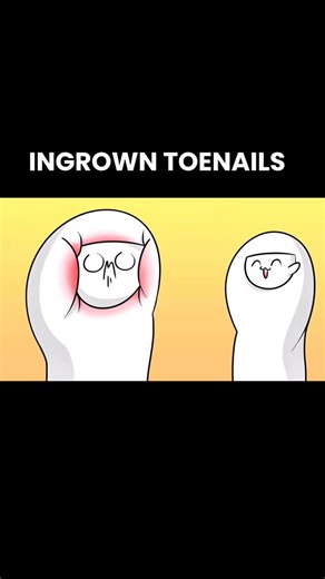 Healthy_Life_Strong on Instagram: "An ingrown toenail occurs when the edge of the nail grows into the surrounding skin. It can cause pain, redness, swelling, and sometimes infection. Common causes include improper nail trimming, tight shoes, or genetic factors. Initial care involves soaking the foot in warm water, using antiseptics, and wearing comfortable shoes. If pain or infection is severe, medical treatment or partial nail removal may be necessary. Regular foot care and proper nail trimming