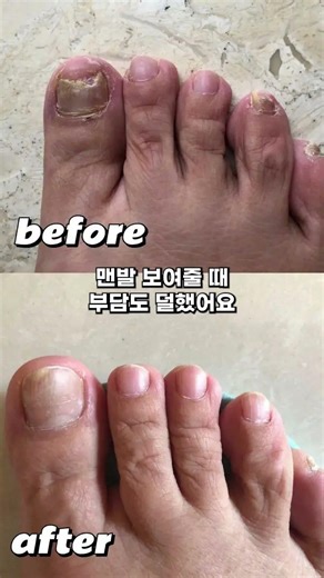 보기 싫게 변한 발톱, 저는 이렇게 관리했어요
