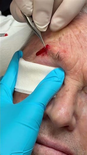 Dermatologist with 50 years experience removes squamous cell carcinoma on eyebrow (part 3 of 4)👨🏻‍⚕️
