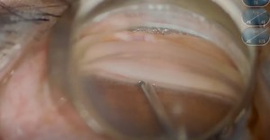 iStent infinite in Eyes With Previous MIGS - Eyetube