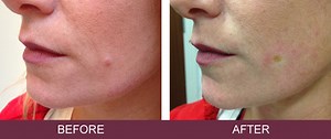Radio Surgical Mole Removal Plymouth & Wells | Skin Excellence Clinic