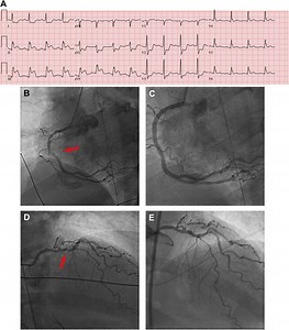 2021 ACC/AHA/SCAI Coronary Artery Revascularization Guidelines for Managing the Nonculprit Artery in STEMI: