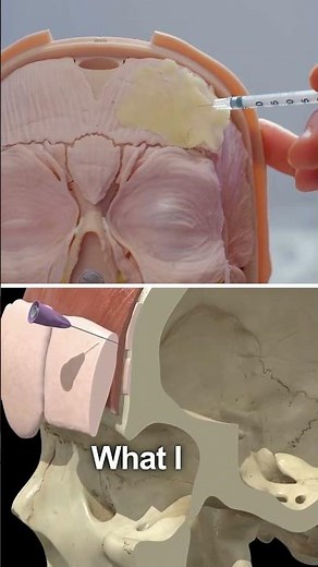 The Botox depth mistake that's costing you.