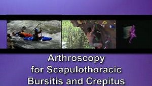 Endoscopic scapulothoracic bursectomy with partial scapulectomy