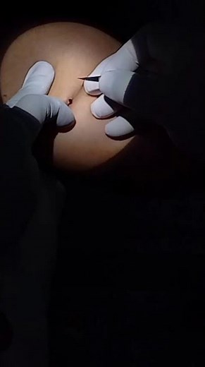 Retiro de implante subdermico IMPLANON NXT planificación familiar