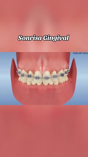 Soluciones para la Sonrisa Gingival con Ortodoncia Avanzada