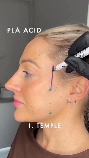 When clients see a PLLA plan mapped out like this, it’s the first time they truly see where their collagen has broken down — and why filler alone isn’t the answer And once they understand the “why,” the whole conversation shifts. They stop focusing on price… and start focusing on results, longevity, and when they can begin. That shift doesn’t happen by chance — it happens through the way you guide the consult and explain regeneration. 👇 Comment CONSULT and I’ll send you the exact framework that