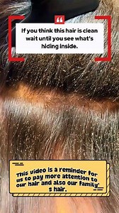 306K views · 962 reactions | Lice eggs cling to almost every strand, and the lice crawl everywhere. An infestation like this doesn’t happen overnight—but there’s always a way to fix it. Watch until the end #HeadLice #Liceeggs #Liceremoval #haircare #Viralvideo #Beautydeals | Ahmad | Facebook