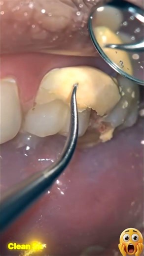 #satisfying #teethdecay #dentalhygiene #dentist #dentalartistry #dentalhealth #cleaning