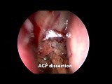 Endoscopic Sinus Surgery for Maxillary Antrochoanal Polyp Excision • Video • MEDtube.net