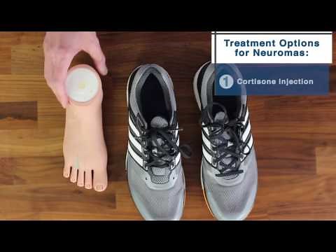 How to Treat Tingly and Painful Neuromas