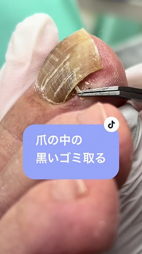 黒い爪の気になるゴミ除去方法
