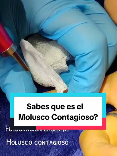 Todo sobre el Molusco Contagioso: Causas y Tratamientos