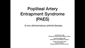 Popliteal Artery Entrapment Syndrome