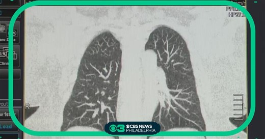American Cancer Society updates screening guidelines for lung cancer