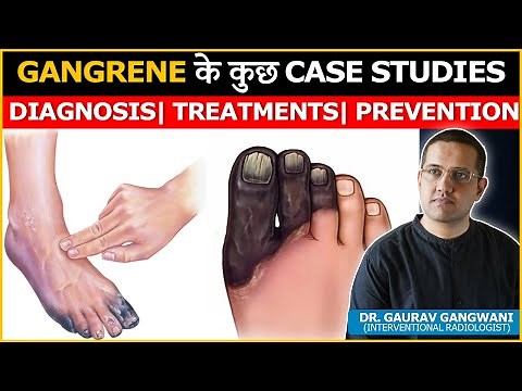 Gangrene and Diabetic Foot, Best Treatment and Case Studies | Dr. Gaurav Gangwani (IR)