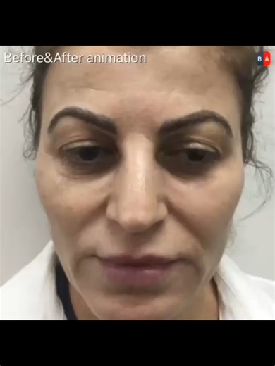 After just four trio treatments, her skin is glowing and here’s why this combo works so well together. ✨ Tixel smooths and resurfaces the top layers, softening texture and prepping the skin like a fresh canvas. RF Needling works deeper, delivering heat into the dermis to tighten, firm and rebuild strong collagen. Laser Resurfacing brightens, evens tone and refines everything for that clear, polished finish. Using all three means we’re treating every layer of the skin: ✔️ surface texture ✔️ deepe