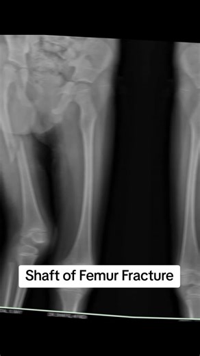 Shaft of Femur Fracture Analysis by Radiologists